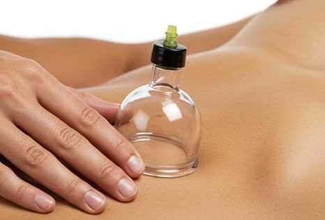 Cupping Therapy in Auckland