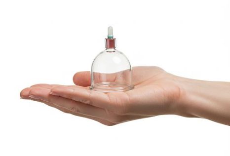 Cupping Therapy in Auckland