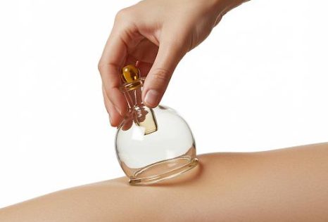 Cupping Therapy in Auckland