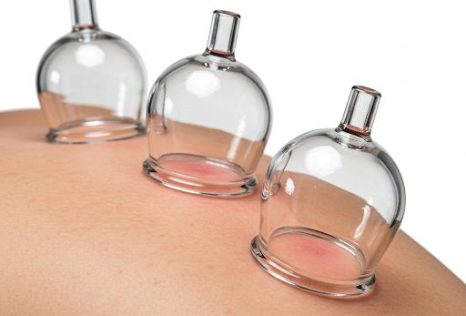 Cupping Therapy in Auckland