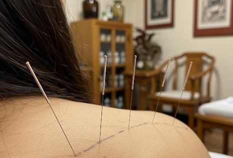 Traditional Chinese Acupuncture in Auckland