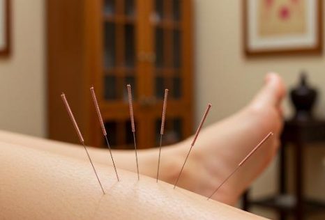 Traditional Chinese Acupuncture in Auckland