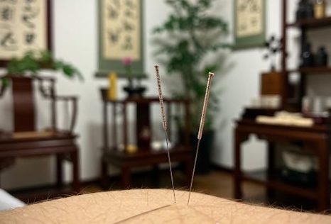 Traditional Chinese Acupuncture in Auckland